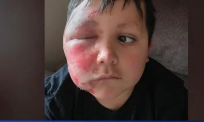 9-Year-Old Illinois Boy Suffers Severe Burns After Microwaving NeeDoh Toy Inspired by TikTok Trend